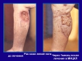 Рак кожи вторичный лимфостаз левой голени