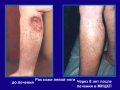 Рак кожи вторичный лимфостаз левой голени