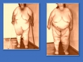 Вторичная лимфедема нижних конечностей. Ожирение 4 ст.