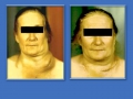 Лимфосаркома шеи слева, вторичный отек лица, шеи